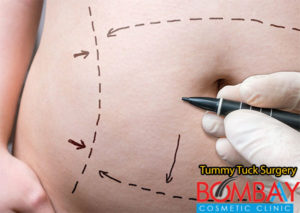 tummy tuck surgery Bombay cosmetic clinic